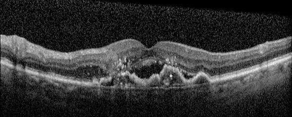 Degeneración Macular Asociada a la Edad